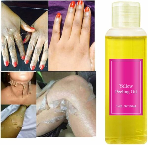 Yellow Peeling Oil Extra Strong Whitening Bleaching Dark Skin Spots Blackheads Blemishes Bad Skin Remover For Body Treatment Gel