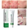 Acne Cream Removal Gel Anti-Acne Oil Control Skin Moisturizing Whiten Care