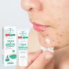 Acne Removal Cream Remove Pimple Acne Scar Cream Herbal Acne Spots Oil Control Gel Whitening