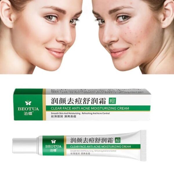 Acne Treatment Gel Skin Care Face Cream Herbal Acne Removal Cream Whitening Moisturizing Shrink Pores Oil Control Pimples