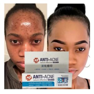 Effective Acne Removal Cream Clears Blemish Pimple Remover Spot Safe Gentle Remove Acne Acne Cream For Clearing Severe Acne