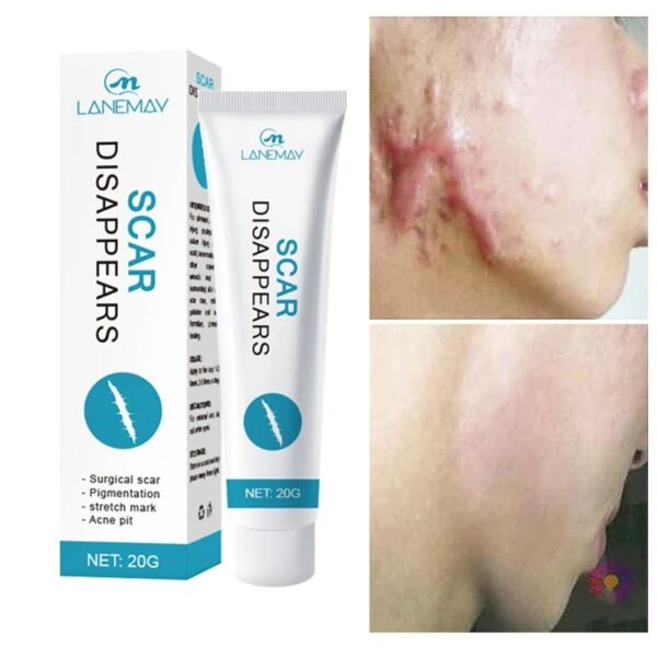 Scar Removal Cream Gel Repaire Pock Mark Burn Surgical Scar Cesarean Scar Stretch Mark Treatment Smooth Moisturize Skin Care