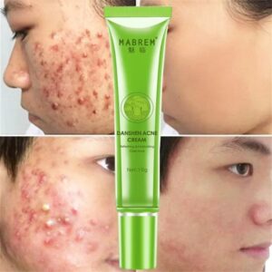 Effective Acne Removal Cream Acne Treatment Fade Acne Spots Oil Control Shrink Pores Whitening Moisturizing Acne Cream Skin Care