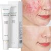 Acne Cream Facial Acne Scar Repair Cream Lighten Acne Marks Herbal Anti-Acne Cream Acne Removal Acne Skin Cream Facial Cream
