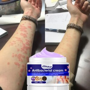Herba Violae Skin  Eczema Fungal Infection Psoriasis Tinea Pedis Relieve Itch Summer Skin Care Cream