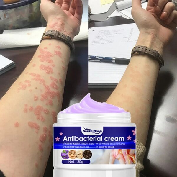 Herba Violae Skin  Eczema Fungal Infection Psoriasis Tinea Pedis Relieve Itch Summer Skin Care Cream