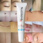 Anti Spot Cream Face Gel Acne Marks Removal Cream Blackhead Removal Striae Gravidarum Pigmentation Corrector Gel