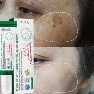 Extracted From Natural Plants Herbal Acne Oil Control Removal Face Cream Skin Care Whitening Eliminate Pimples Facial Cream