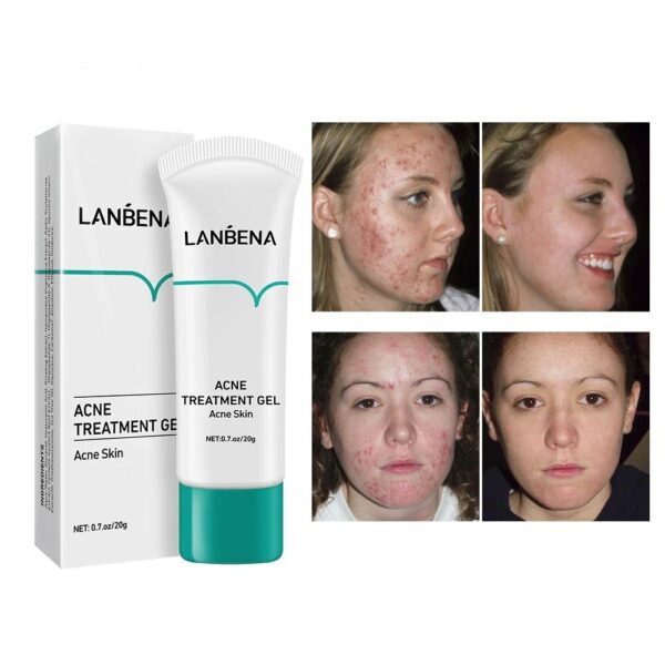 Acne Treatment Gel Acne Deep Cleansing Fragrance Free Non-Comedogenic Cleansing Facial Foam Cleanser