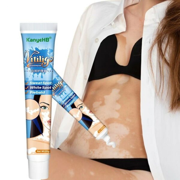 Ointment Remove Ringworm White Spot Removal Skin White Spot Cream