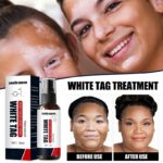 White Spot Remover Spray Leukoplakia Disease Melanin Skin Repair Cream For Face And Body Topical Spot Liquid Skin Care