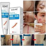 Scar Repair Cream Stretch Marks Removal Surgical Scald Burn Caesarean Section Scar Acne Whitening Body Skin Care