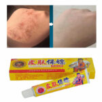 Atopic DermatiTis Eczema Cream The Perfect Psoriasis Ointment Dermatitis Anti Fungal Lnfection Body Cream
