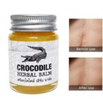 Crocodile Scar Removal Cream Thailand Herbal Balm Whitening Remover Acne Marks Scar Face Corrector Stretch Pigmentation