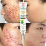 Herbal Acne Removal Cream Fade Pimples Spots Treatment Anti-acne Oil Control Acne Mark Whitening Moisturizing Gel Skin Care