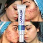 Pure Herbal Acne Removal Cream Whitening Moisturizing Shrink Pores Oil Control Pimples Acne Treatment Gel Skin Care Face Cream