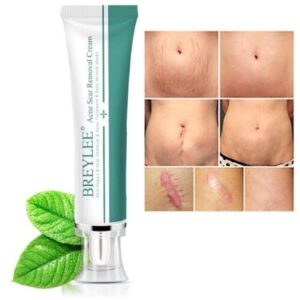 Scar Removal Cream Stretch Marks Removal Acne Scars Skin Repair Whitening Cream Dark Spot Remover For Face Skin Care