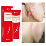 Acne Scar Removal Cream Pimples Stretch Marks Face Gel Remove Acne Smoothing Whitening Moisturizing Body Skin Care