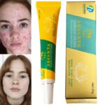 Herbal Chamomile Acne Removal Cream Skin Care No Stimulation Acne Traditional Chinese Medicine Treatment Facial Cream