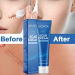 Acne Scar Removal Cream Gel Skin Care Stretch Marks Remove Acne Spots Surgical Scars Treatment Smooth Whitening Beauty Cosmetics