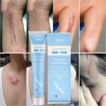 Herbal Essence Skin Scar Removal Cream For Burns Surgery Plastic Surgery Hyperplasia Acne Marks Stretch Marks Pigment Skin Care