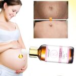 Stretch Marks Remover Essential Oil Skin Care Treatment Cream For Stretch Mark Removal Maternity Slackline For Pregnant Oils