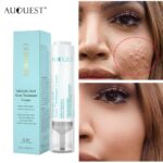 Salicylic Acid Acne Face Cream Oil Contro Whitening Facial Treatment Hyaluronic Black Dots Remove Shrink Pores Skin Care