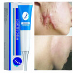 Effective Scar Cream Burn Surgical Scars Remover Cesarean Scar Repairing Stretch Marks Whitening Pock Acne Marks Smoothing Skin