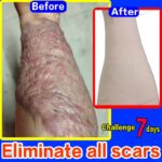 Scar Removal Cream Scar Repair Gel Fade Scars Burn Caesarean Section Stretch Marks Acne Pits Acne Marks Surgical Scars