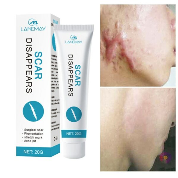 Scar Removal Cream Gel Repaire Pock Mark Burn Surgical Scar Cesarean Scar Stretch Mark Treatment Smooth Moisturize Skin Care 20g 1