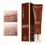 Scar Repair Cream Stretch Marks Acne Remove Promote Cell Regeneration Freckles Spots Removal Skin Care