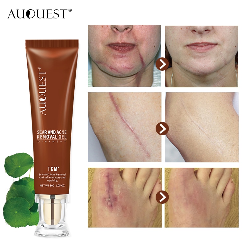 Scar Repair Cream Stretch Marks Acne Remove Promote Cell Regeneration Freckles Spots Removal Skin Care 7