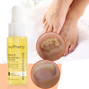 Nail Fungus Treatment Serum Foot Fungus Feet Toe Anti Infection Onychomycosis Nail Fungus Remedy Essence Beauty Health