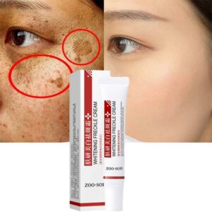 Effective Whitening Freckle Cream Remove Dark Spots Anti Freckle Cream Niacinamide Fade Pigmentation Melasma Brighten Creams 1