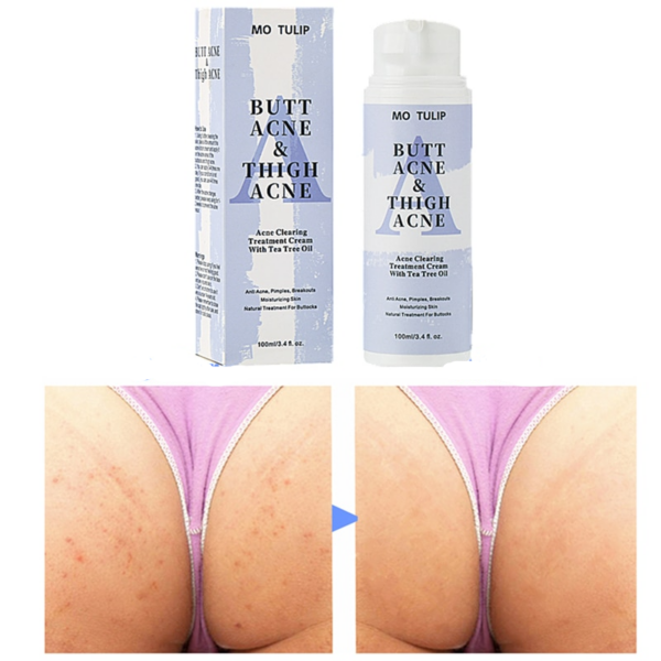 Butt Acne Clearing Spot Treatment Cream Clears Acne Pimples Zits Razor Bumps and Dark Spots for the Buttocks Thigh Area