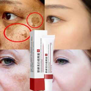 Whitening Freckle Cream Remove Dark Spots Anti Aging Cream Fade Pigmentation Melasma Brighten Serum Skin Care 1