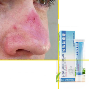 Red Nose Ointment Remove Blackhead Acne Cream Skin Care Herbal Anti Acne and Mite Acne Rosacea Treat Shrink Pores