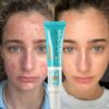 Remove Blackheads Marks Spots Oil Control Whitening