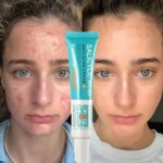 Remove Blackheads Marks Spots Oil Control Whitening