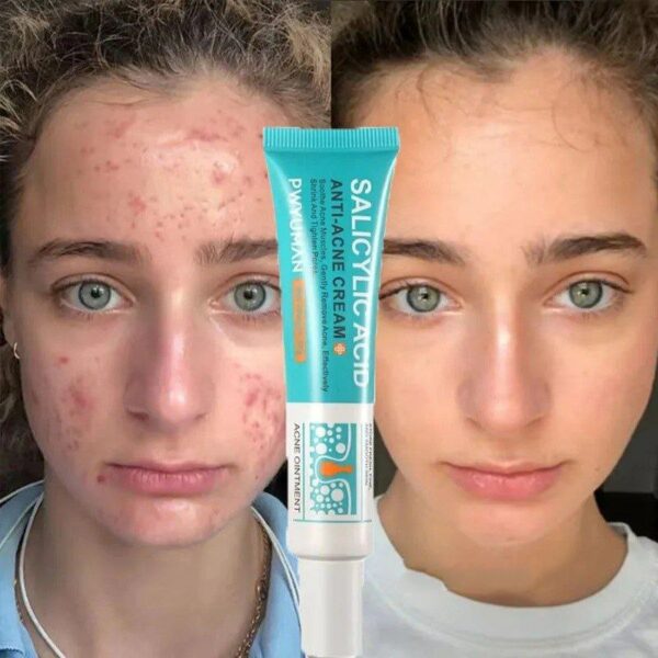 Remove Blackheads Marks Spots Oil Control Whitening