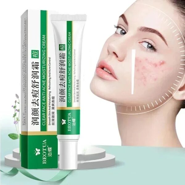 Herbal Acne Treatment Cream Face Scar Blackhead Remover Repair Gel Oil Control Shrink Pores Whitening Skin Care