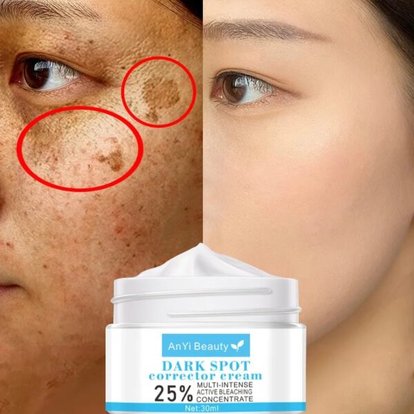Dark Spot Removal Whitening Skin Cream Remove Melasma Acne Spot Pigment Melanin Dark Spot Pigmentation Moisturizing Gel