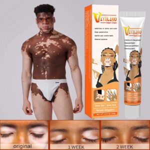 Effectively Remove Vitiligo Ointment Remove Ringworm White Spot Removal Skin Vitiligo Eliminate Vitiligo Skin Care
