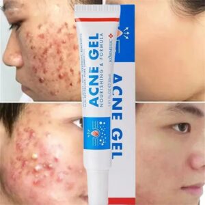 Effective Acne Removal Cream Anti-Acne Repair Redness Pimple Spots Gel Deep Cleaning Pore Oil Control Moisturizing Skin Care