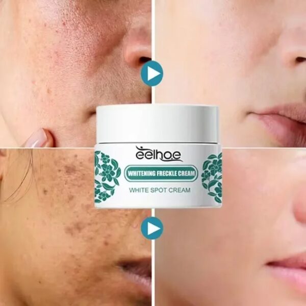 Whitening Freckles Face Cream Remove Melasma Dark Spots Lighten Melanin Acne Scar Anti-aging Brighten Face Skin Care