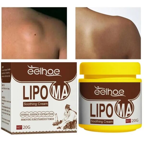 Lipoma Removal Cream Relief Pain Treat Skin Swelling Lipolysis Cellulite Fat Lump Nodule Removal Smoothing Cream