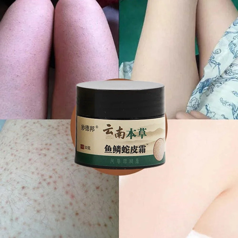 Repair Chicken Skin Cream Curing Body Dark Spot Keratosis Follicle Pilaris Remove Thick Pore Moisturizing Smooth Essence Lotion