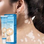 Moisturizing Cream For Vitiligo Therapy Ointment | White Spots Removing Cream To Improve Skin Pigmentation