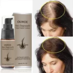 Powerful Hair Growth Serum Spray Ginger Anti Hair Loss Treatment Products Loss Postpartum Hair Fast Regrowth Hair