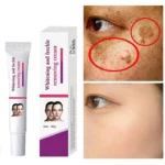 Facial Spots Cream Freckles Removal Skin Dark Spot Remove Melasma Age Spots Sunspots Whitening And Freckle Removing Cream